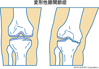 【変形性膝関節症を改善するための治療方法】